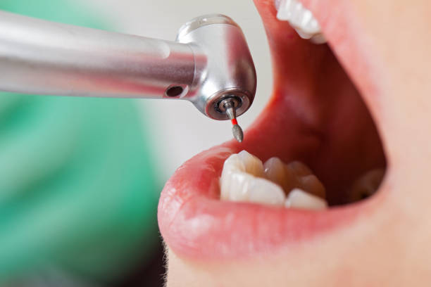 Best Emergency Dental Extractions in Sapulpa, OK